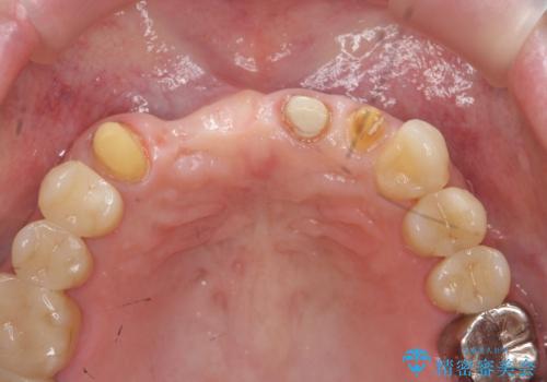 前歯が折れた 前歯部審美セラミックブリッジ治療の治療中