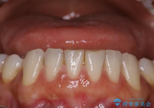 全体の総合的な治療前にPMTCの治療前