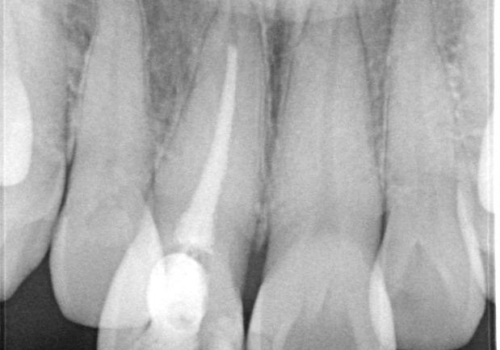 前歯の色が気になる、オールセラミッククラウンによる治療の治療前