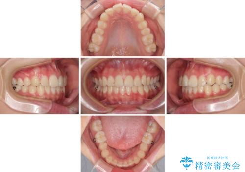 前歯のデコボコを改善 インビザライン矯正の治療中