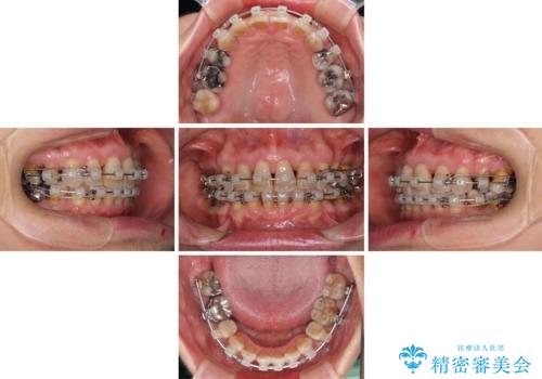出っ歯を改善した後に真っ白な歯に 矯正歯科治療と審美歯科治療の治療中