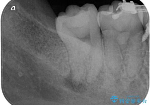 奥の歯茎にニキビみたいなものができた!の治療前