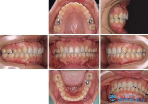 受け口傾向の前歯 すきっ歯の改善の治療後