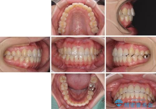 口元の突出感を改善 インビザラインによる非抜歯矯正の治療後