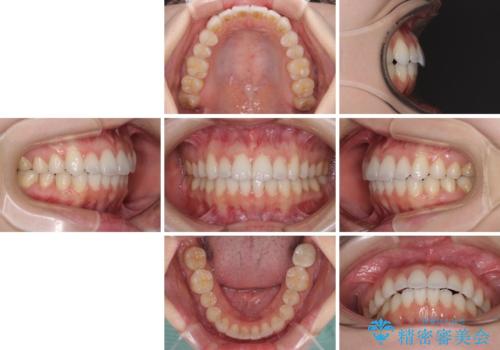 インビザライン・ライトにより後戻りの再矯正の治療後