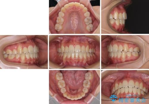 前歯の正中のズレを改善 目立たないワイヤー装置での抜歯矯正の治療後