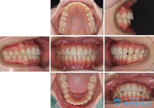 軽微な歯列不正をワイヤー矯正で整えるの治療後