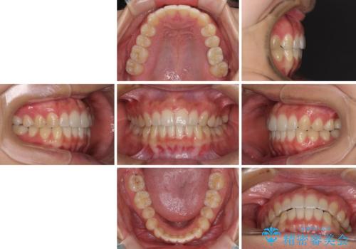 インプラントによる補綴治療とインビザライン矯正の治療後
