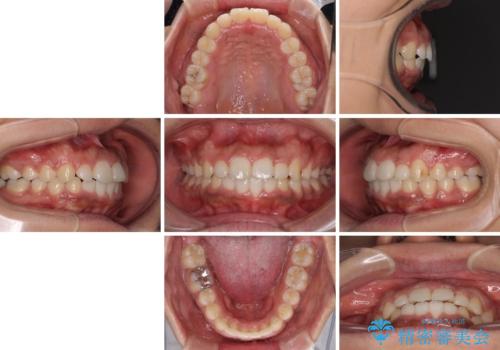 インビザラインが続けられない ワイヤー装置での矯正治療の治療後