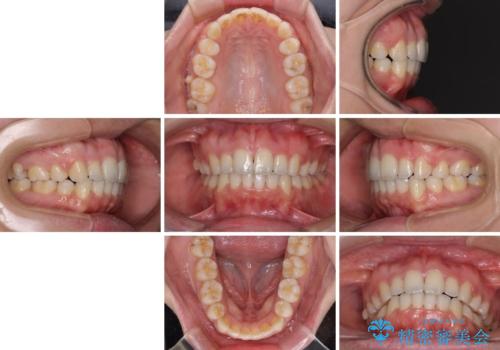 口元をスッキリと ワイヤー装置による抜歯矯正の治療後