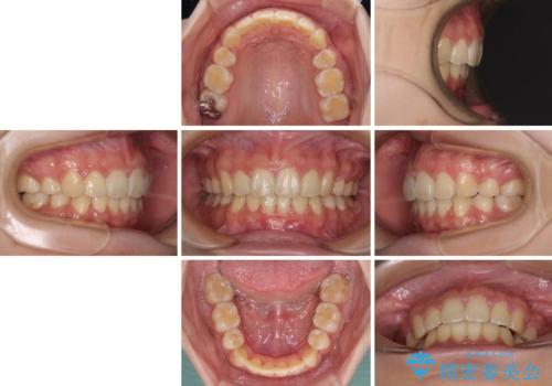 部分矯正で出っ歯になった　出っ歯改善の抜歯矯正の治療後