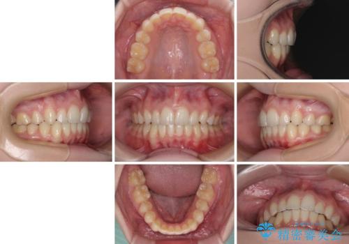 八重歯を短期間で改善 ワイヤー装置による抜歯矯正の治療後