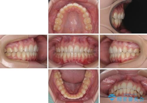 八重歯を短期間で改善　ワイヤー装置による抜歯矯正の治療後