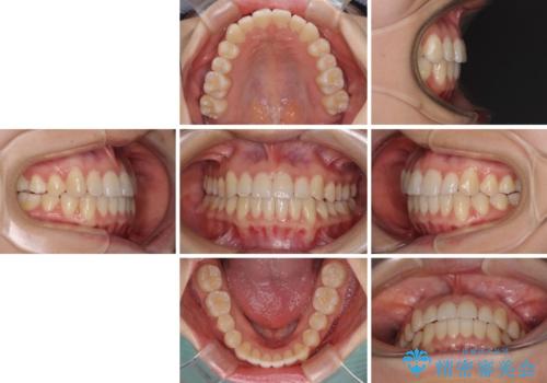 前歯のクロスバイト インビザラインによる矯正治療の治療後