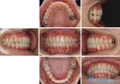 【モニター】幅の狭い上顎歯列 骨幅を拡大する矯正治療の治療後