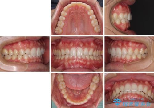 細かい隙間にものがはさまる インビザラインによる矯正治療の治療後