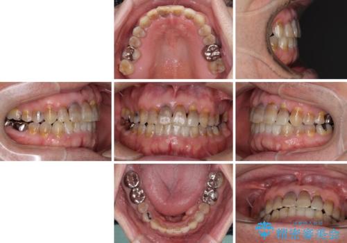 上顎の狭窄歯列 インビザラインによる拡大矯正の治療後