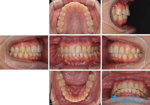 ディープバイトと叢生を解消 インビザライン矯正の治療後
