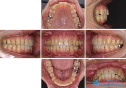 前歯のデコボコと下顎の八重歯　インビザラインによる矯正治療の治療後
