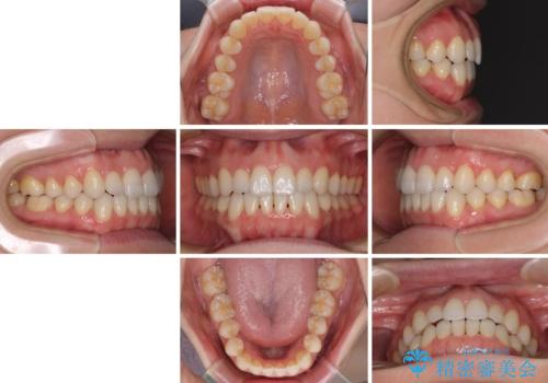 前歯の叢生とオープンバイト インビザラインでの矯正治療の治療後