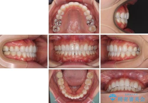 軽度の叢生をインビザライン・ライトで解消の治療後