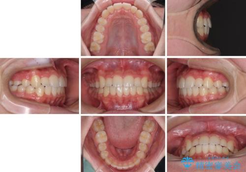 中学生のワイヤー矯正 クロスバイトを短期間で改善の治療後