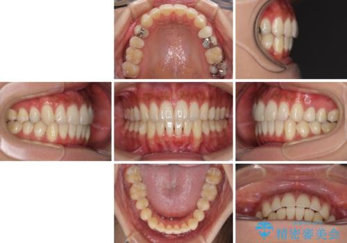 八重歯の再矯正 インビザラインでストレスなく矯正治療の治療後