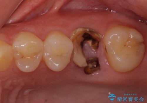 インプラントによる補綴治療とインビザライン矯正の治療前
