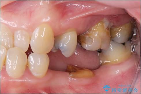 歯周病　ブリッジ補綴の症例 治療前