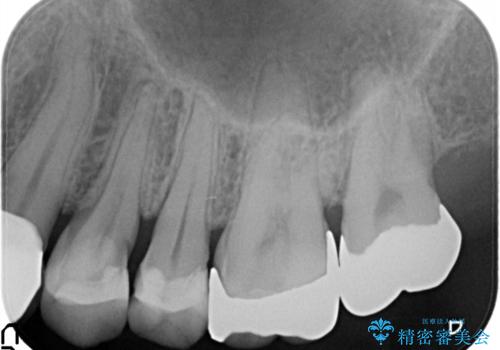 縁下カリエス オールセラミッククラウンの治療前