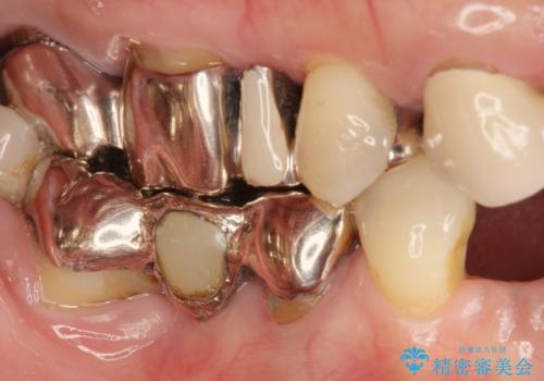 インプラント治療で達成するしっかりと食事できる噛み合わせの症例 治療前