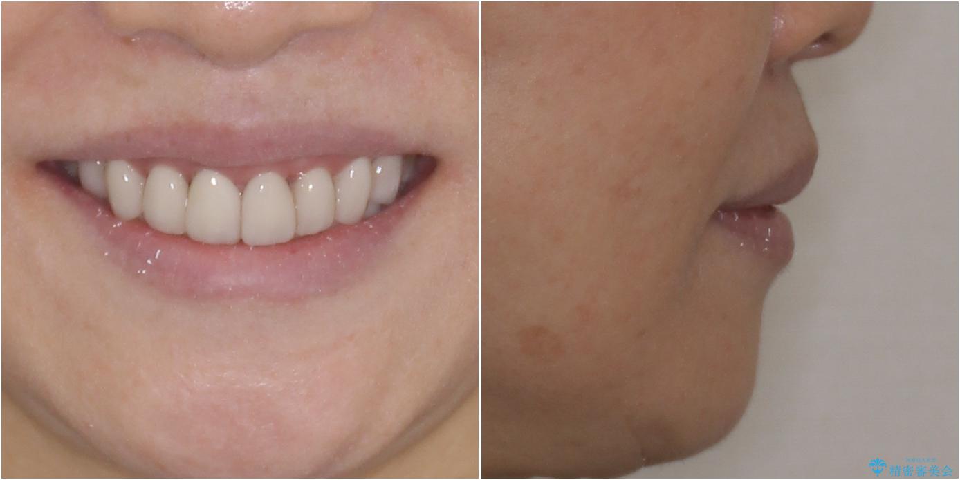 出っ歯を改善した後に真っ白な歯に 矯正歯科治療と審美歯科治療の治療後(顔貌)