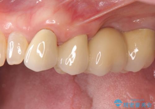 歯周病　ブリッジ補綴の治療後