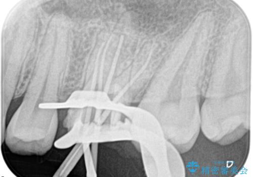 大きい虫歯 根管治療〜オールセラミッククラウンの治療後