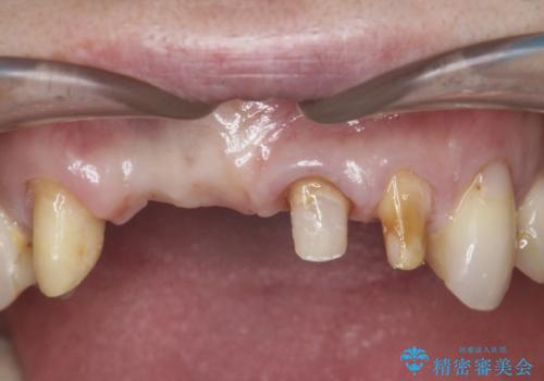 前歯が折れた 前歯部審美セラミックブリッジ治療の治療中