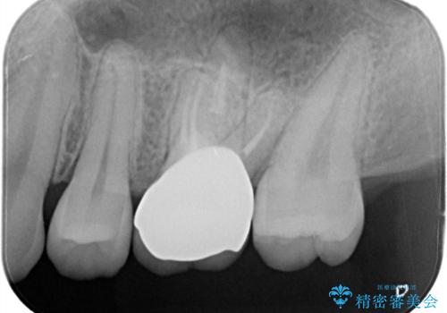 大きい虫歯 根管治療〜オールセラミッククラウンの治療後