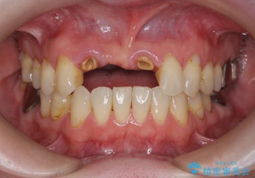 前歯が折れた 前歯部審美セラミックブリッジ治療の治療前