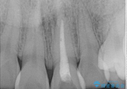 前歯を綺麗にしたい オールセラミッククラウンの治療前