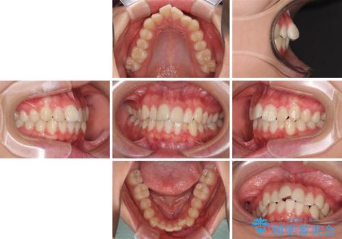 前歯のデコボコを改善 インビザライン矯正の治療前