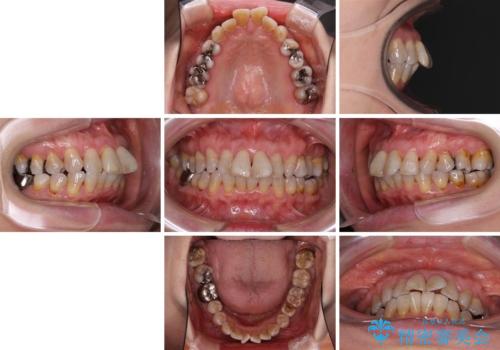 出っ歯を改善した後に真っ白な歯に 矯正歯科治療と審美歯科治療の治療前