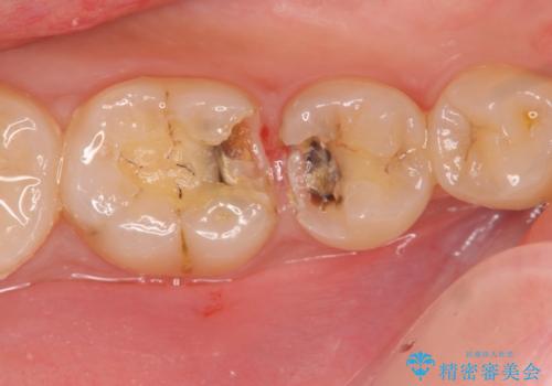 コンポジットレジン修復下で再発する虫歯の治療中