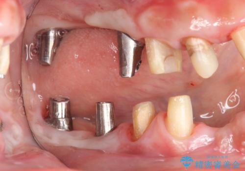 インプラント治療で達成するしっかりと食事できる噛み合わせの治療中