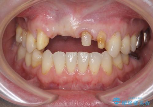 前歯が折れた 前歯部審美セラミックブリッジ治療の治療中