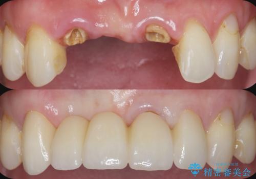 前歯が折れた 前歯部審美セラミックブリッジ治療