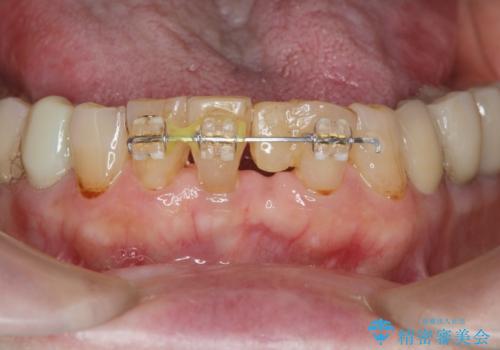 [MTMを行い歯の神経を保存] 歯周補綴ブリッジの治療中