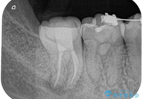 奥の歯茎にニキビみたいなものができた!の治療後