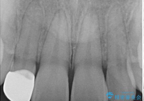 マウスピース矯正とセラミックの組み合わせ治療の治療後