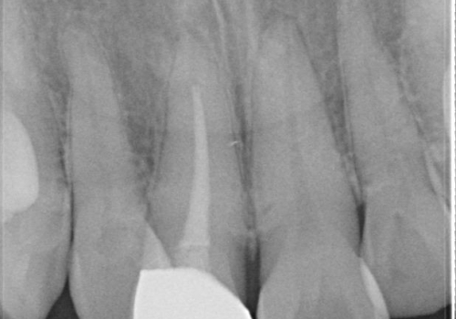 前歯の色が気になる、オールセラミッククラウンによる治療の治療後