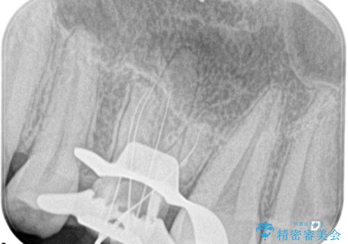 大きい虫歯 根管治療〜オールセラミッククラウンの治療前