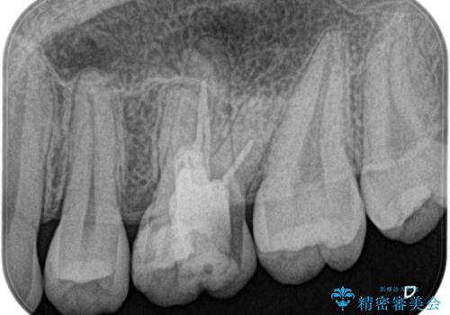 大きい虫歯 根管治療〜オールセラミッククラウンの治療前